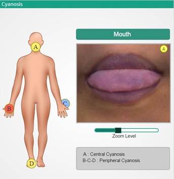 peripheral cyanosis