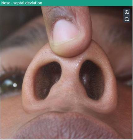 deviated nasal septum types