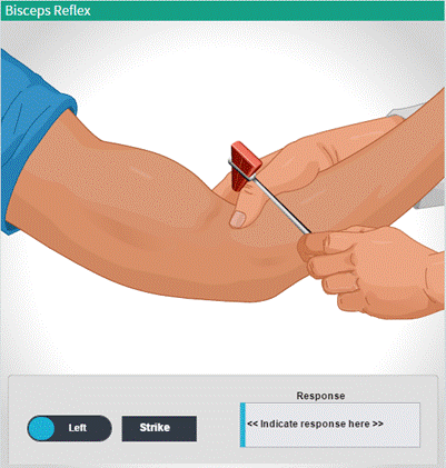 brachioradialis reflex