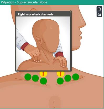 Palpation Supraclavicular Node