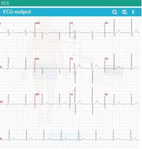 ecg-normal.jpg